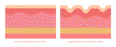 collagen in younger skin and aging graphic