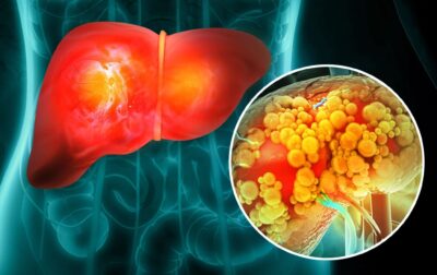 fatty liver