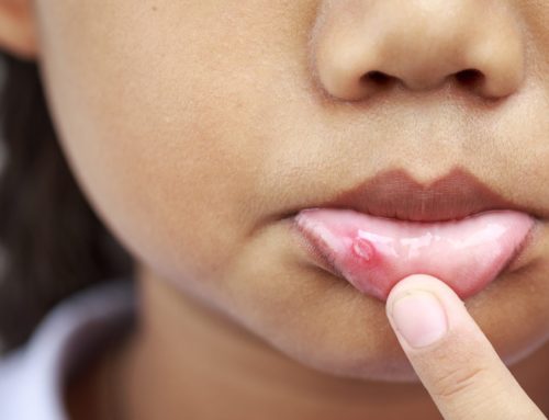 5 Top Tips For Preventing And Healing Mouth Ulcers