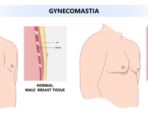 What causes gynecomastia (breast growth in men)?