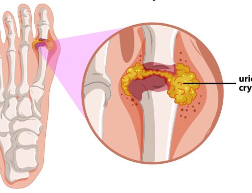Gout may be caused by fatty liver