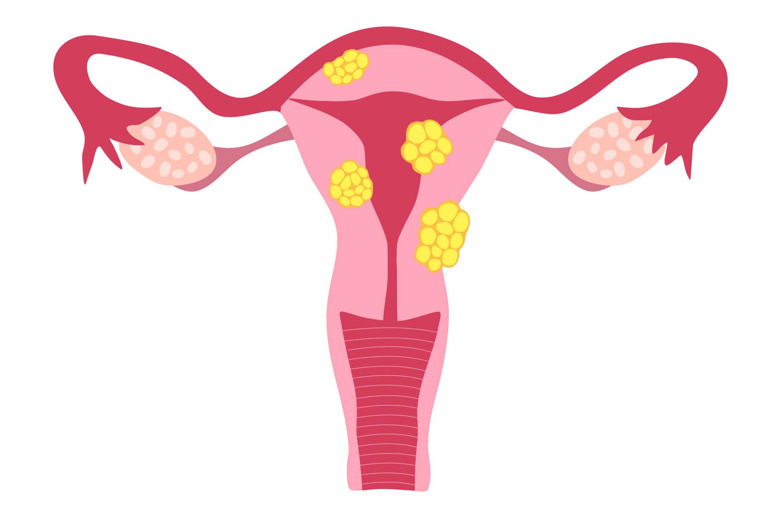 Uterine fibroids linked to higher heart disease risk